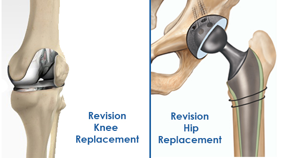 Best Hip Replacement Doctor in Jaipur, India